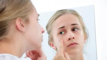 ¿Cómo tratar el acné juvenil? ¿Cómo tratar el acné juvenil?