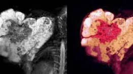 Día Internacional del Sarcoma: extraño cáncer de huesos y tejidos blandos