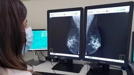 Revelan una nueva diana terapéutica para contrarrestar el cáncer de mama
