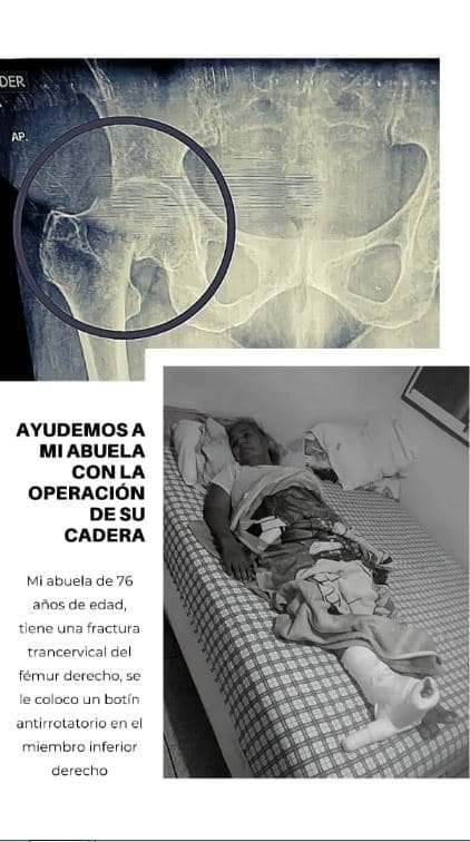 Servicio Público: Virginia Marcano requiere ayuda para operación de cadera