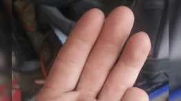 Se corta su dedo meñique y lo encuentra seis meses después