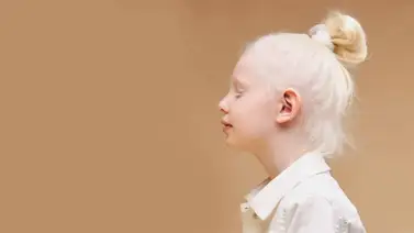 Día Internacional de Sensibilización sobre el Albinismo Día Internacional de Sensibilización sobre el Albinismo