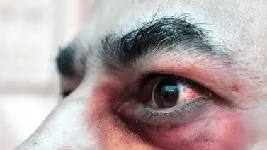 Se reportan dos casos de muerte por la infeción del Hongo Negro Se reportan dos casos de muerte por la infeción del Hongo Negro