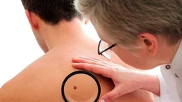 23 de mayo: Día Mundial contra el Melanoma