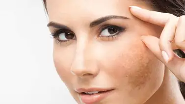 Aclara la piel y quita las manchas de tu rostro Aclara la piel y quita las manchas de tu rostro