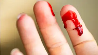 Conoce que es la Hemofobia, el miedo a la sangre y a las heridas Conoce que es la Hemofobia, el miedo a la sangre y a las heridas