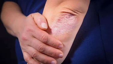 Psoriasis, trastorno crónico de la piel