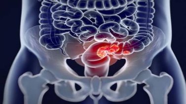 Analizan la relación entre bacterias intestinales y el cáncer de colon