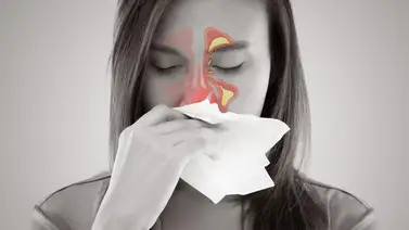 Conoce todo sobre la sinusitis Conoce todo sobre la sinusitis