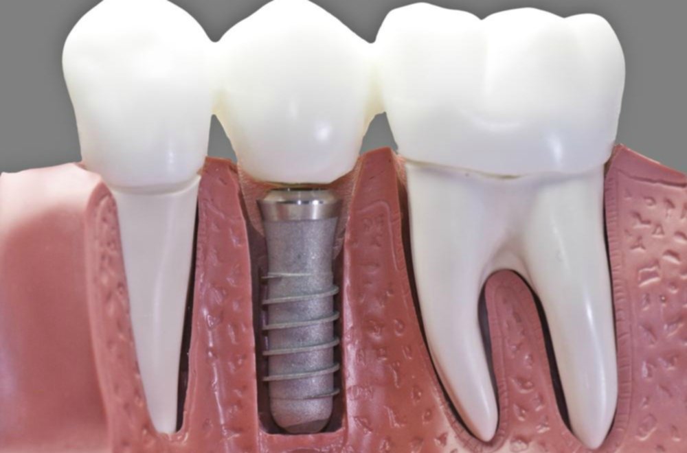 El uso de los implantes dentales para una mejor actitud El uso de los implantes dentales para una mejor actitud