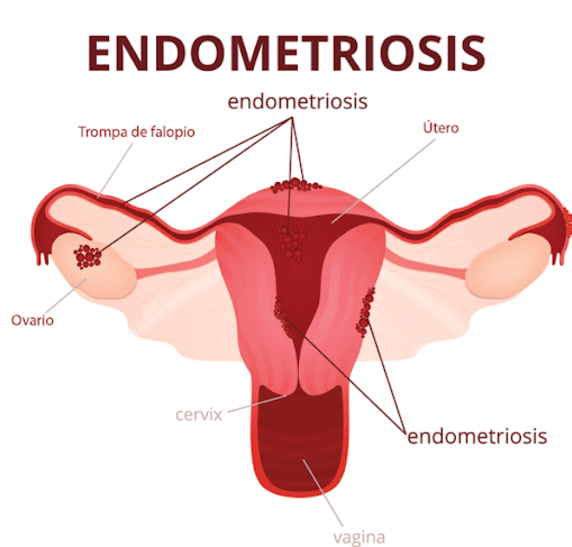 Endometriosis, la enfermedad de las mujeres que los hombres no terminan de reconocer