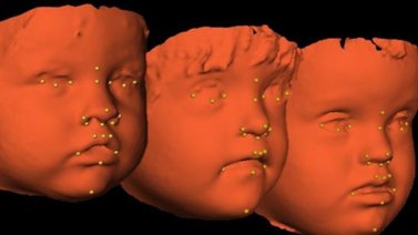 Científicos descubren cómo reducir deformaciones faciales en niños con síndrome de Down