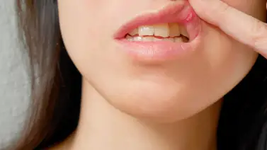 Causas, síntomas y tratamientos para las aftas Causas, síntomas y tratamientos para las aftas