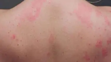 Advierten lesiones en la piel tras contagios por la COVID-19 Advierten lesiones en la piel tras contagios por la COVID-19