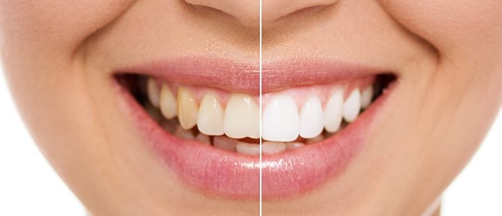 7 Consejos para blanquear los dientes 7 Consejos para blanquear los dientes
