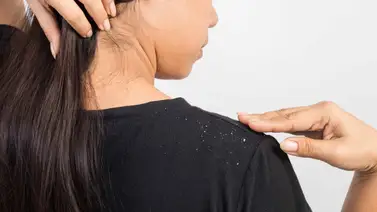 Mascarillas para eliminar la caspa Mascarillas para eliminar la caspa