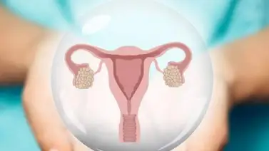 Qué son los ovarios poliquísticos Qué son los ovarios poliquísticos