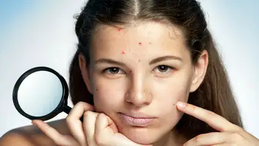 Remedios caseros contra el acné Remedios caseros contra el acné