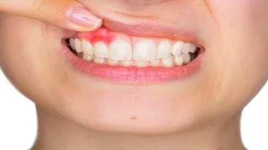 Investigadores explican cómo la periodontitis puede causar demencia