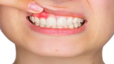 Investigadores explican cómo la periodontitis puede causar demencia Investigadores explican cómo la periodontitis puede causar demencia