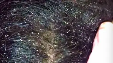 Niña de 12 años muere por infestación de piojos Niña de 12 años muere por infestación de piojos