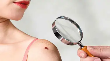 Todo lo que debes saber sobre los lunares Todo lo que debes saber sobre los lunares