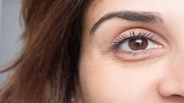 Causas y soluciones de las ojeras