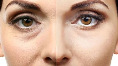 Blefaroplastia, un procedimiento quirúrgico que logra un asombroso rejuvenecimiento de la piel