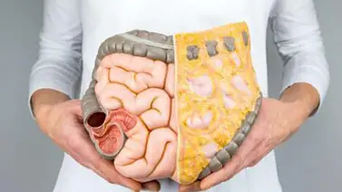 El cáncer de colón es un 70% curable si se detecta a tiempo El cáncer de colón es un 70% curable si se detecta a tiempo