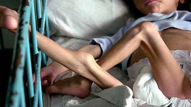 Ciudadanía en Acción aseguró que al menos 1,6 millones de niños sufren desnutrición aguda en Venezuela