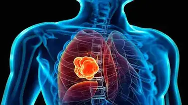 Investigan nuevos usos para vacuna terapéutica cubana contra cáncer de pulmón Investigan nuevos usos para vacuna terapéutica cubana contra cáncer de pulmón