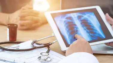 El cáncer de pulmón avanza sigilosamente El cáncer de pulmón avanza sigilosamente