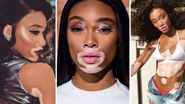 Conoce a la nueva modelo con vitiligo de Victoria’s Secret’s (+Fotos)