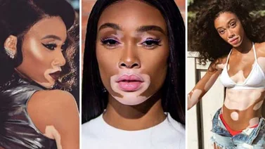 Conoce a la nueva modelo con vitiligo de Victoria’s Secret’s (+Fotos)