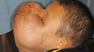 Cirujanos extirparán un tumor facial de 4,5 kilos a un niño cubano en Miami Cirujanos extirparán un tumor facial de 4,5 kilos a un niño cubano en Miami