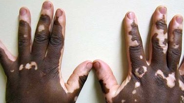 Conozca qué es el vitíligo, sus causas y consecuencias, según experta