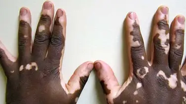 Conozca qué es el vitíligo, sus causas y consecuencias, según experta Conozca qué es el vitíligo, sus causas y consecuencias, según experta