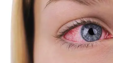 Un virus "muy resistente" es causante de brote de conjuntivitis en Nicaragua Un virus "muy resistente" es causante de brote de conjuntivitis en Nicaragua