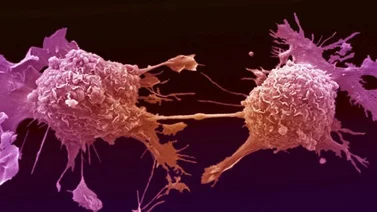 Logran predecir la metástasis del "melanoma" y encuentran una "diana terapéutica"