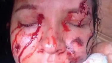 Ornelys Salas tiene perdigón alojado en el cerebro luego de represión en Táchira Ornelys Salas tiene perdigón alojado en el cerebro luego de represión en Táchira