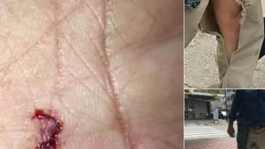 Diputado Williams Dávila resultó lesionado en mano y pierna durante manifestación Diputado Williams Dávila resultó lesionado en mano y pierna durante manifestación