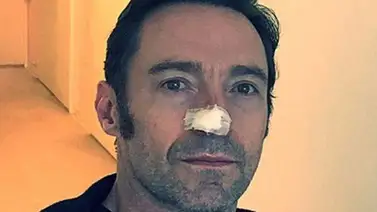 Hugh Jackman es operado por nuevamente a causa del cáncer de piel Hugh Jackman es operado por nuevamente a causa del cáncer de piel