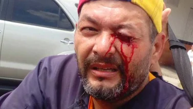 Dirigente de Primero Justicia en Barinas perdió un ojo por un perdigonazo (+Video y fotos)