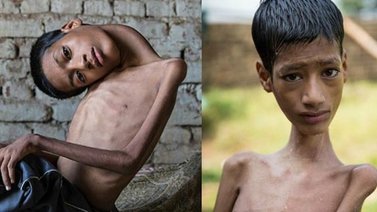 Niño indio cuyo cuello colgaba fue operado con éxito