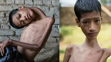 Niño indio cuyo cuello colgaba fue operado con éxito Niño indio cuyo cuello colgaba fue operado con éxito