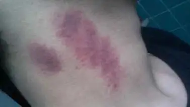 Adolescente muere a causa de un chupón que le hizo su novia Adolescente muere a causa de un chupón que le hizo su novia