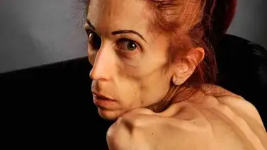 Rachael Farruj superó la anorexia Rachael Farruj superó la anorexia