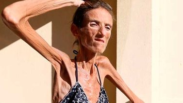 Mujer de 40 años pesa 25 kilos