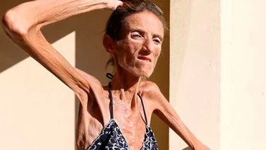 Mujer de 40 años pesa 25 kilos