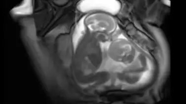 Mira la pelea de estos gemelos en el vientre de su madre Mira la pelea de estos gemelos en el vientre de su madre